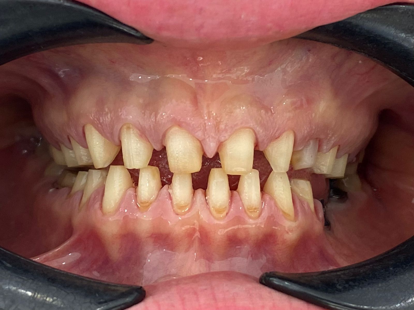 Prima — abrasione dentale