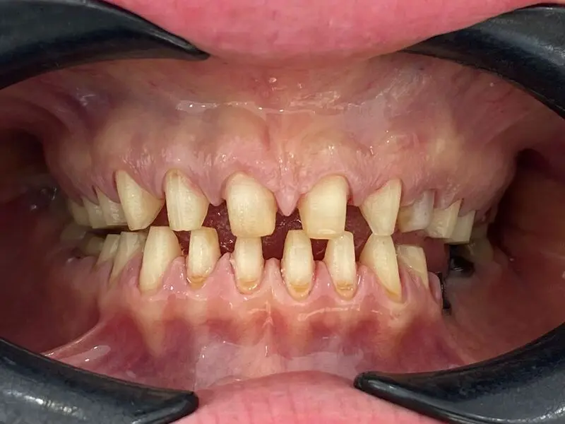 Prima — abrasione dentale