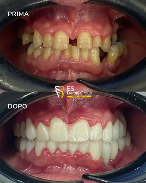 Prima e dopo — usura dentale